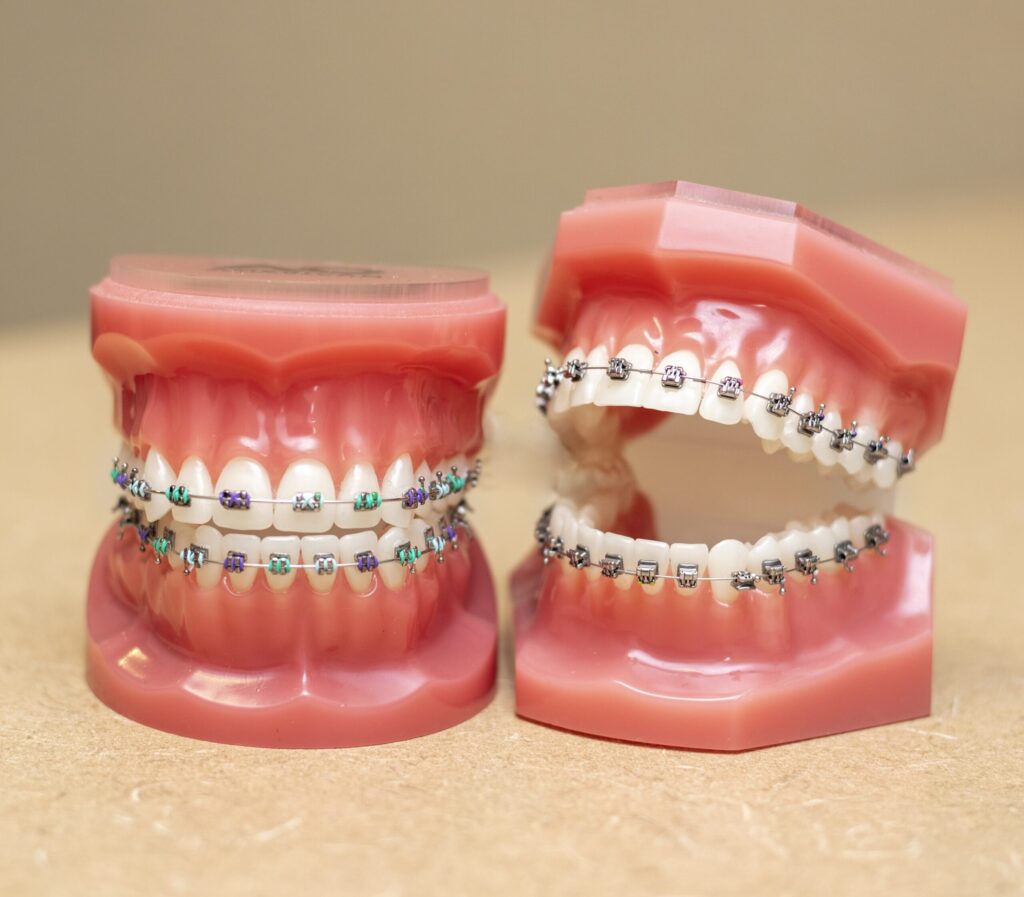 Two pairs of custom braces on dental models, one with cerulean and purple and the other silver
