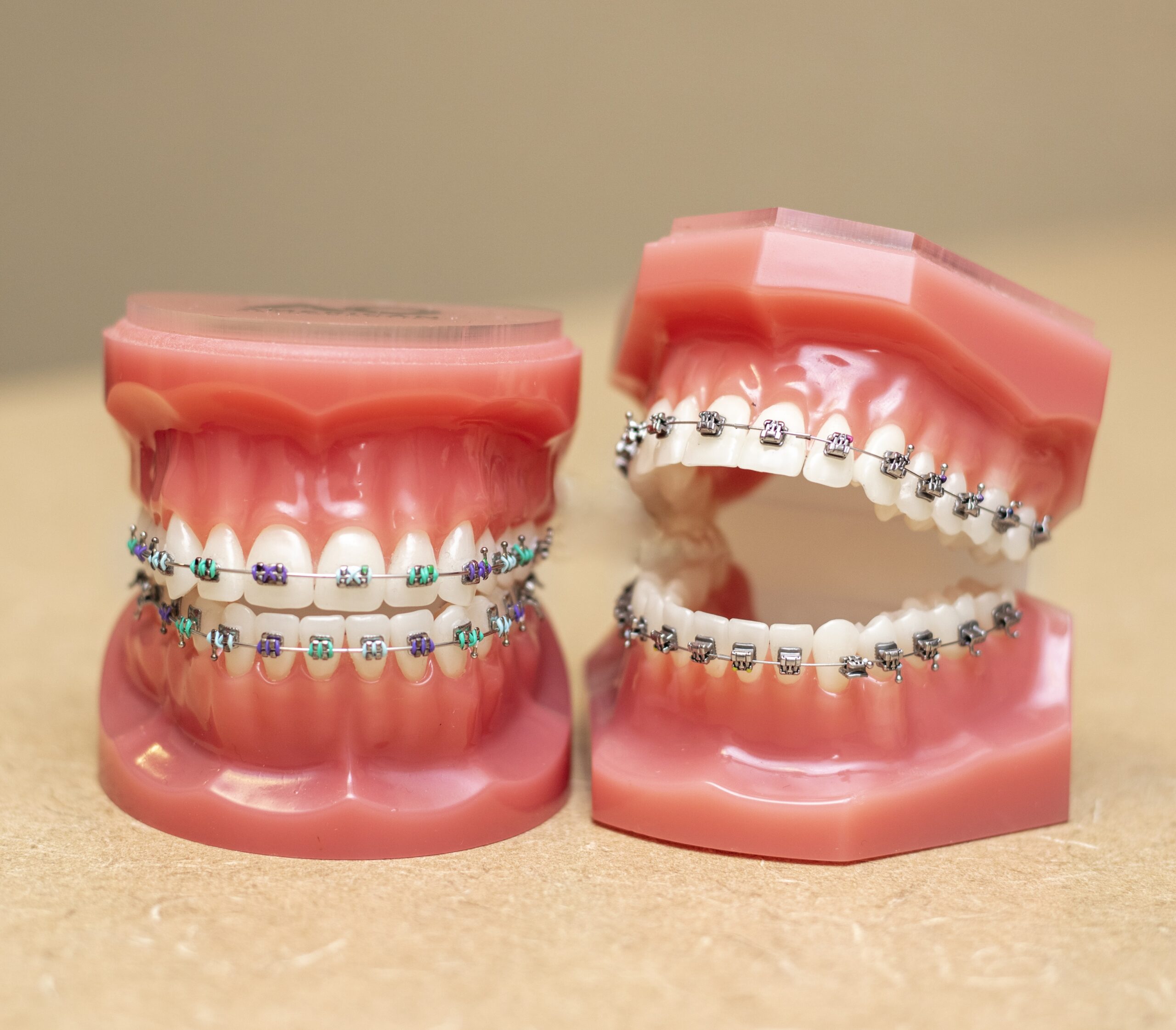 Two pairs of custom braces on dental models, one with cerulean and purple and the other silver