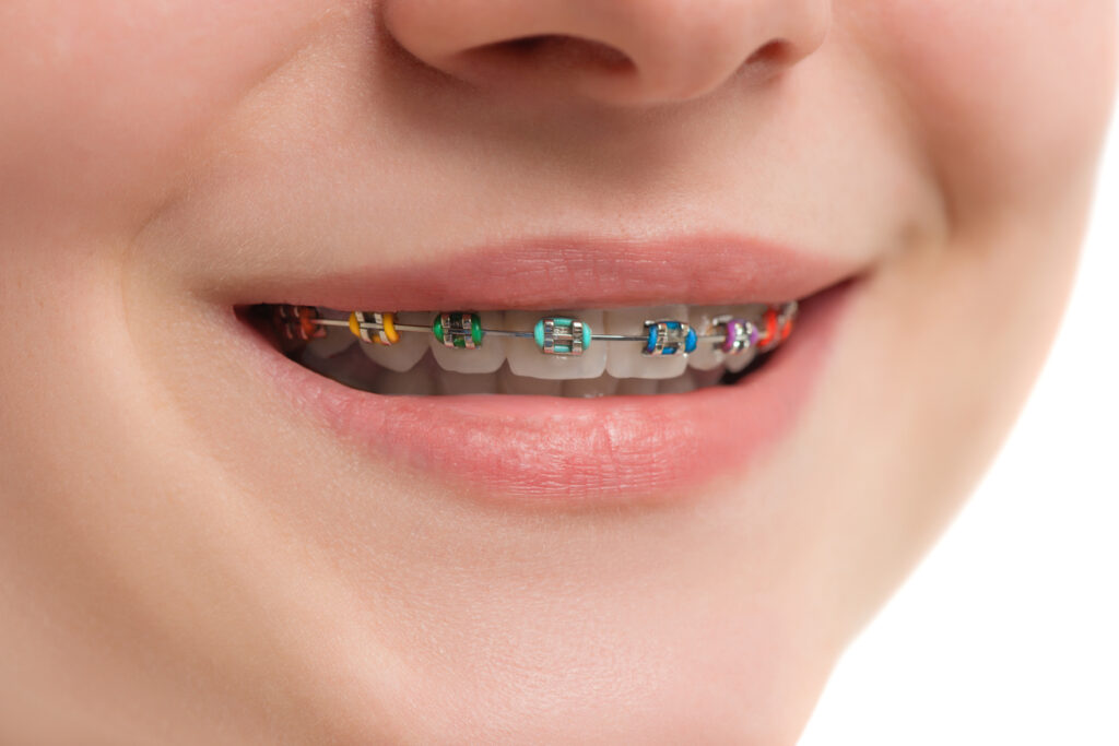 Close up of the smile of a young woman with multicolored braces brackets