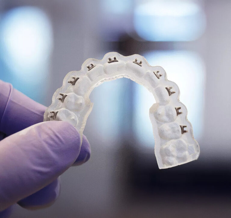 Custom 3-D printed indirect bonding tray held by a hand in a purple latex glove