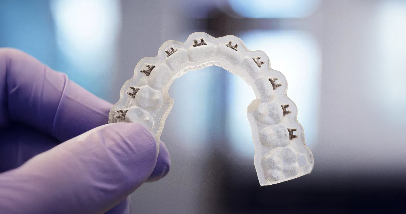 Custom 3-D printed indirect bonding tray held by a hand in a purple latex glove