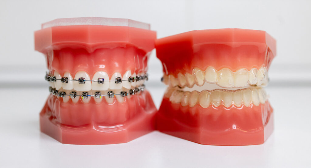 Dental models with braces and clear aligners