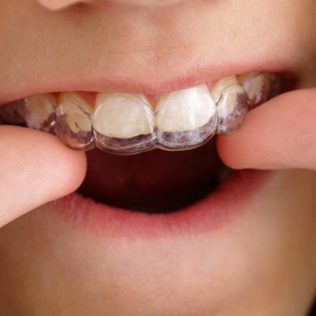 Retainer putting to the teeth
