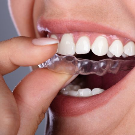 Close-up,Of,A,Woman’s,Hand,Putting,Transparent,Aligner,In,Teeth Close-up,Of,A,Woman's,Hand,Putting,Transparent,Aligner,In,Teeth